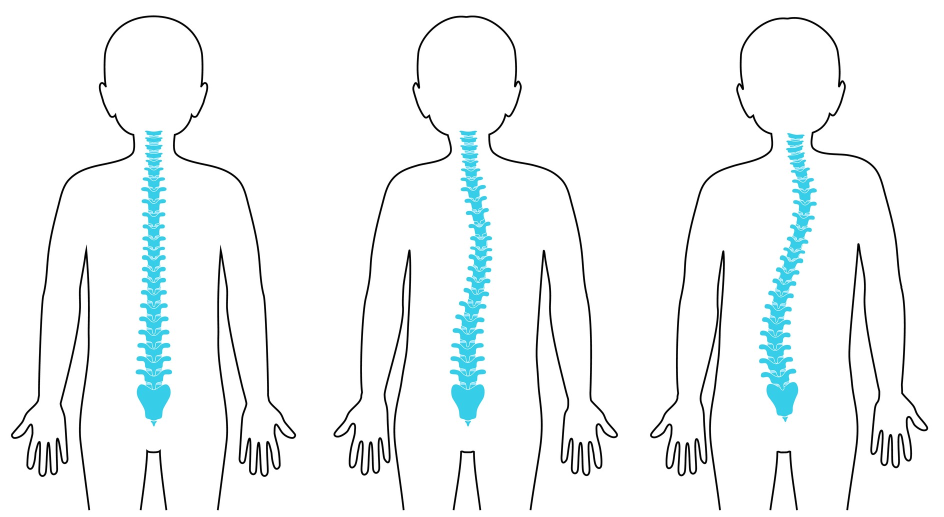 Diagnosing & Treating Scoliosis in Children - The Pediatric Orthopedic ...