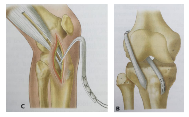 An illustration depicting surgery for an ACL tear