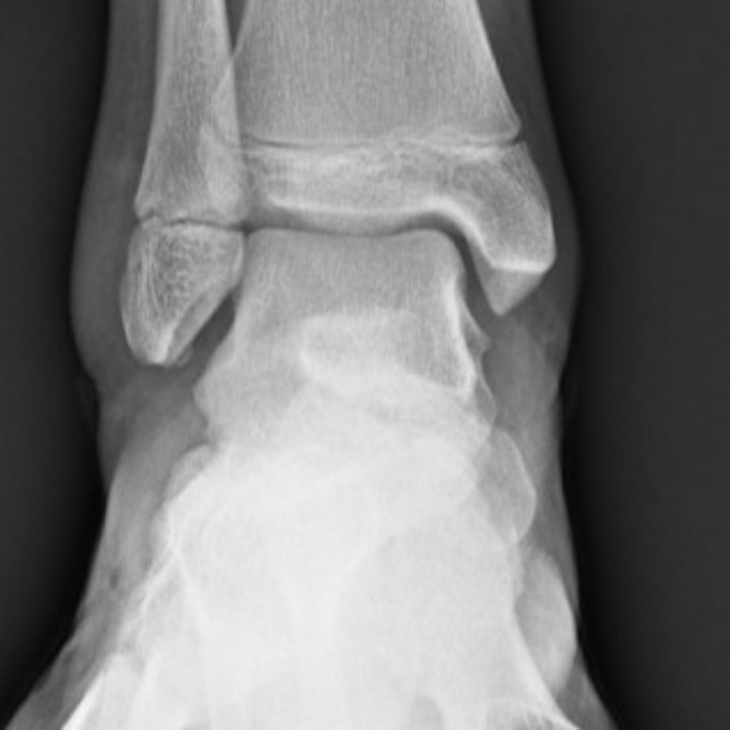 an xray of an ankle