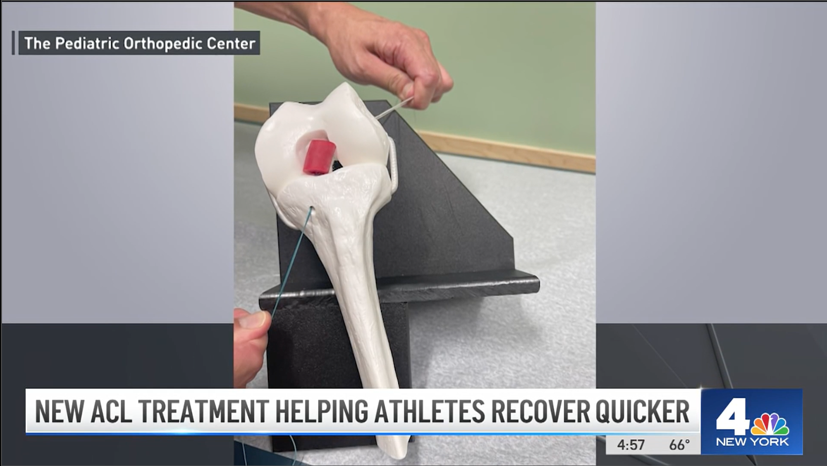 A still from the NBC New York story on New ACL Treatment Helping Athletes Recover Quicker