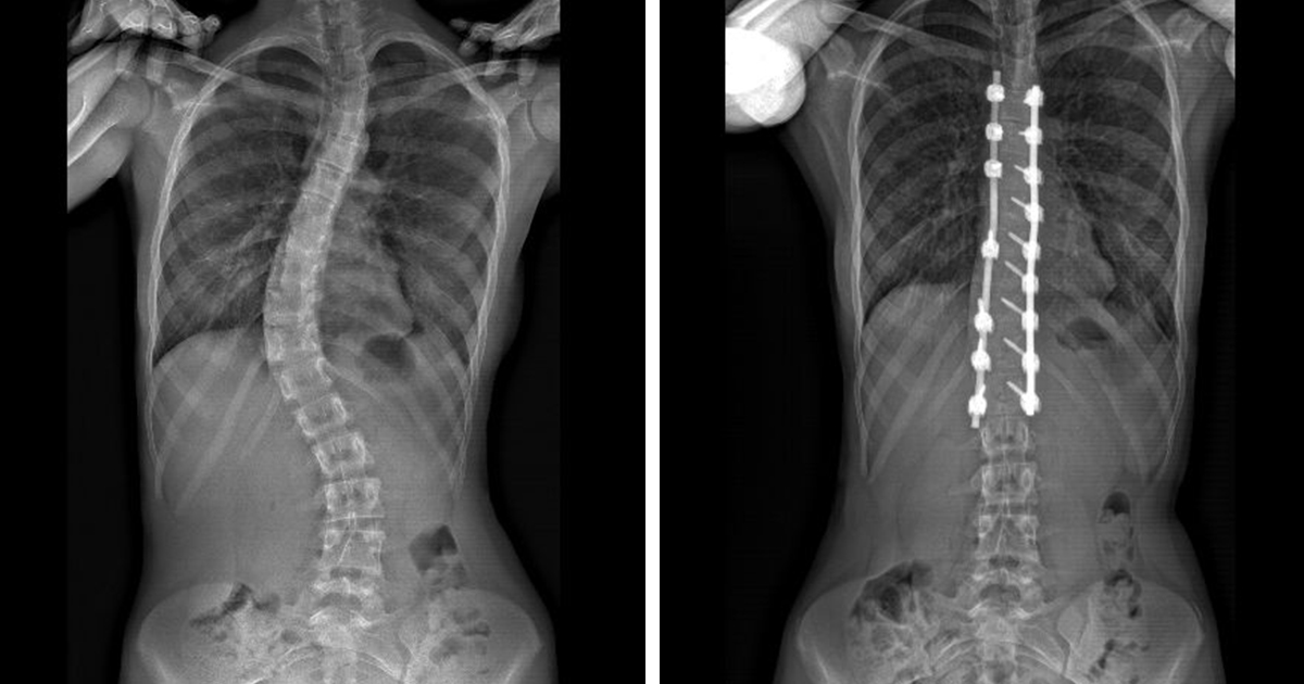a before and after of scoliosis surgery on a spine