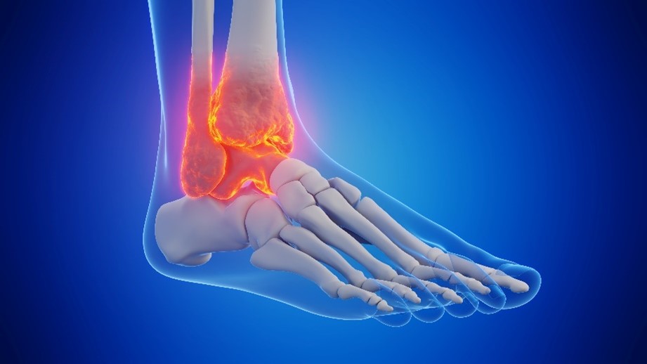 A 3D render of bones in a foot with the ankle red and inflamed